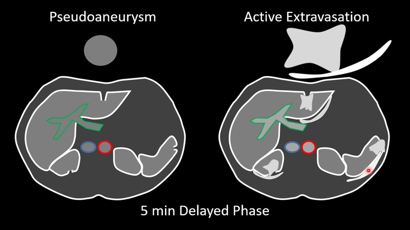 Blunt Abdominal Trauma Part 1 Vascuary