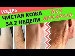 Как быстро избавиться от дерматита Как очистить кожу за 2 недели без мазей и лекарств ИЗДР5