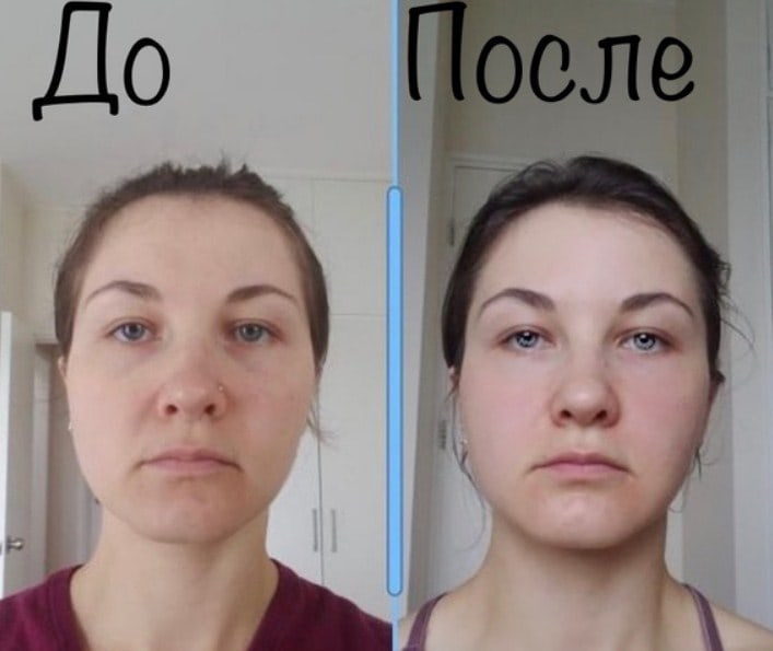 Тейпирование лица отзывы до и после фото Тейпирование лица отзывы до и после фото